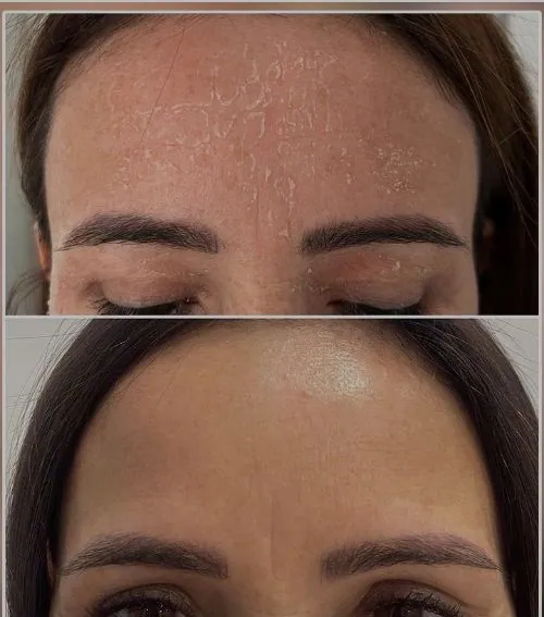 Stirn vor und nach Bio Microneedling