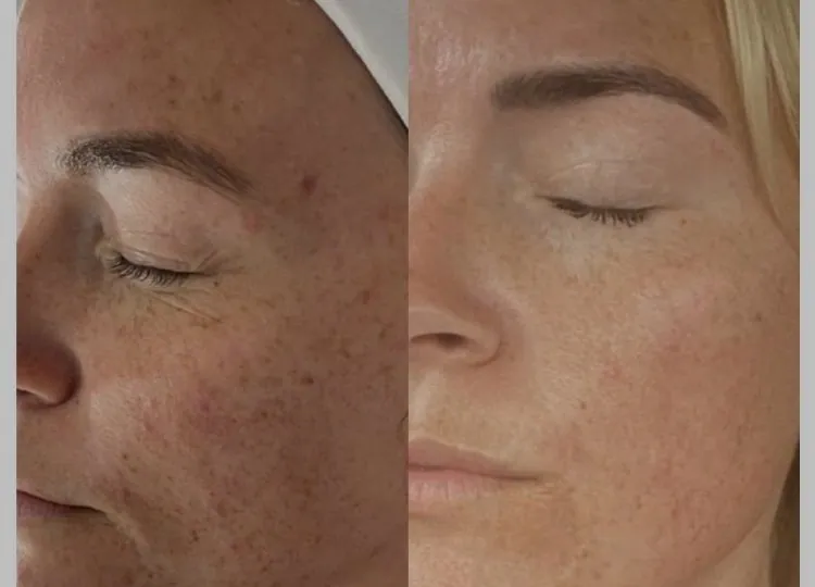 Haut vor und nach Bio Microneedling
