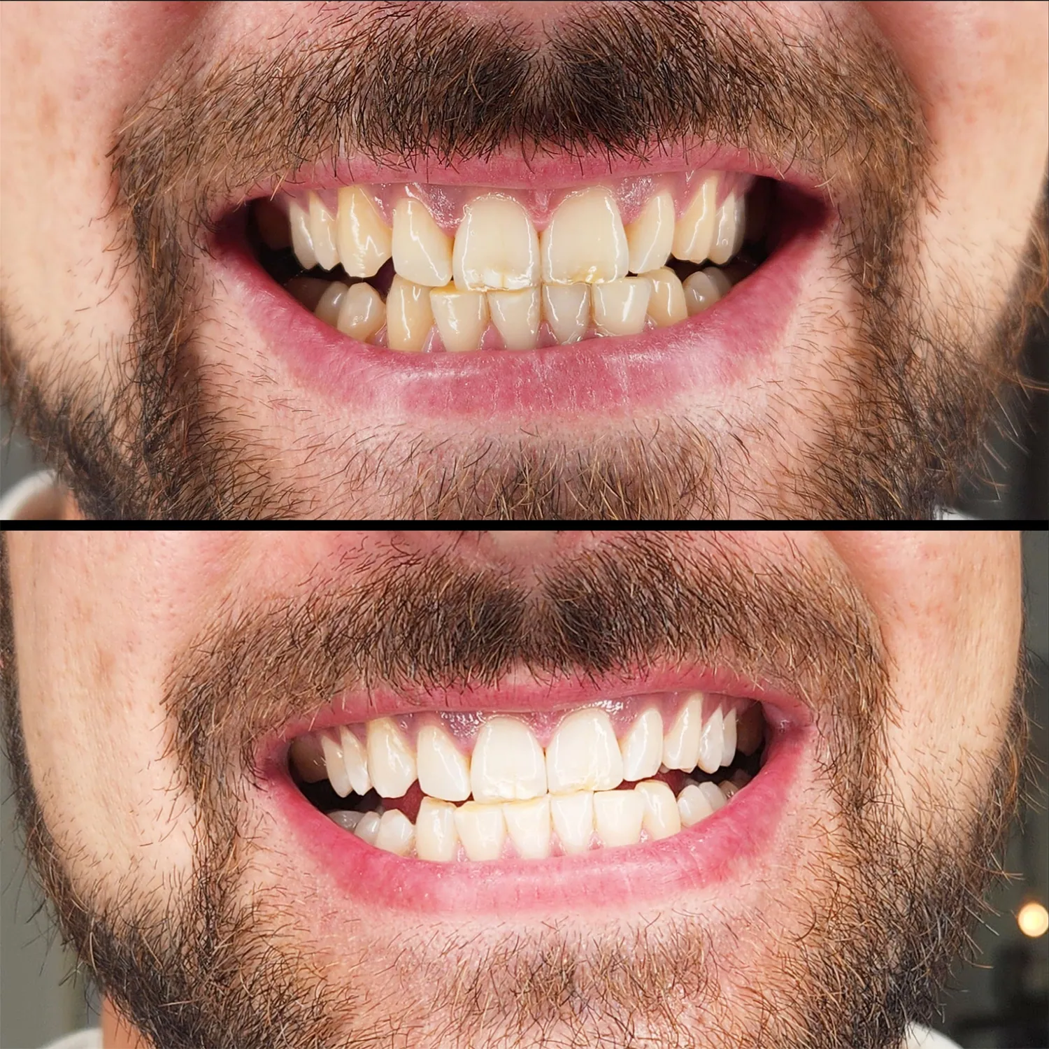 Zähne vor und nach dem Zahnbleaching